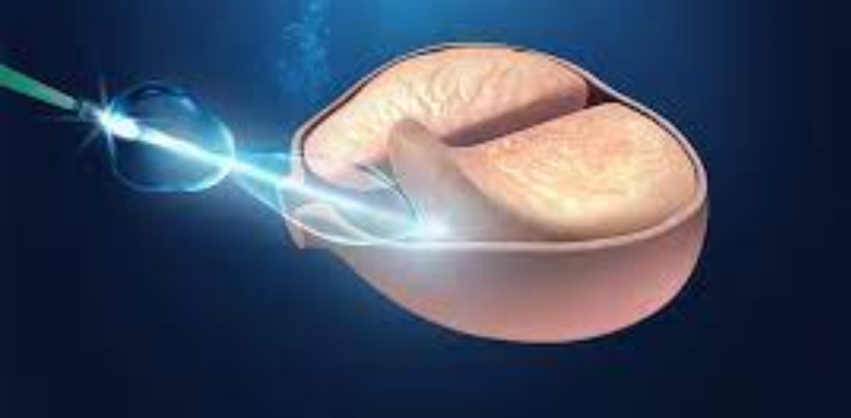 Laser Enucleation of Prostate