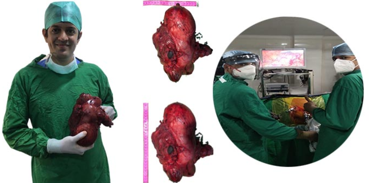 Laparoscopic Urology Surgery