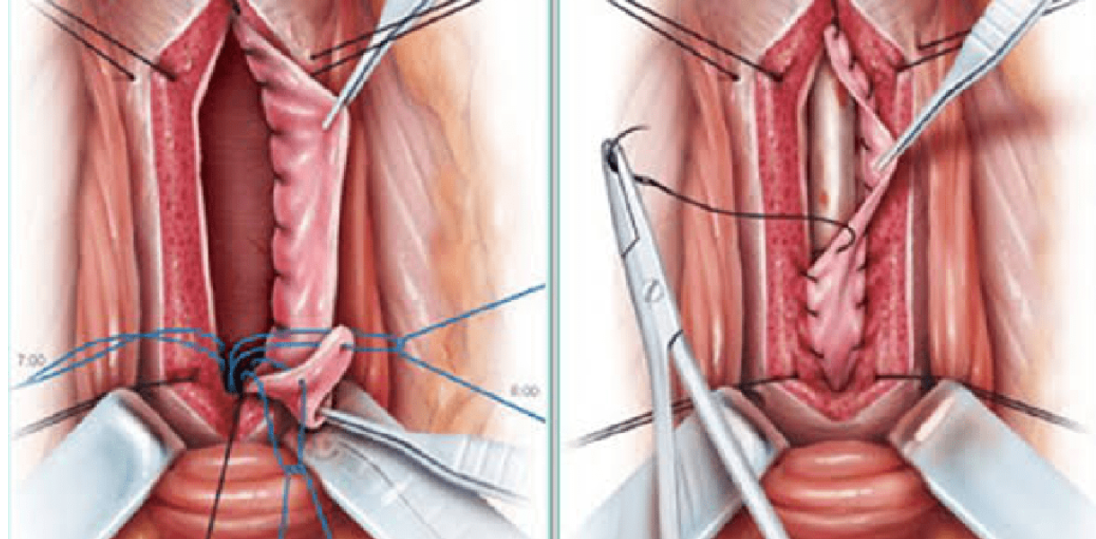 Urethroplasty Surgery