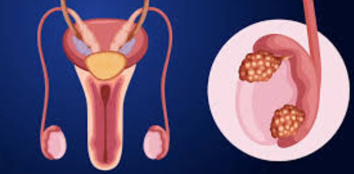 Testicular Cancer Treatment